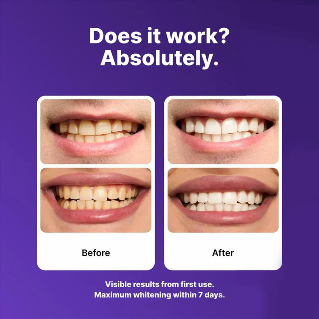 💜Purple Teeth Whitening Strips - Safe for Enamel✨🦷
