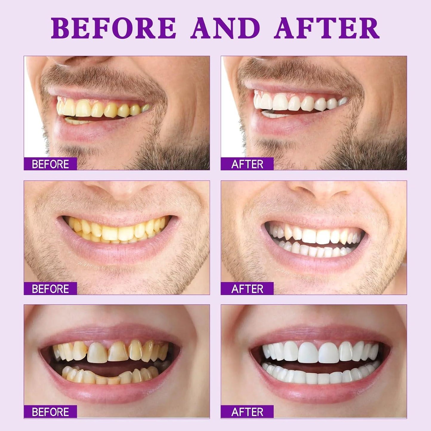 💜Purple Teeth Whitening Strips - Safe for Enamel✨🦷