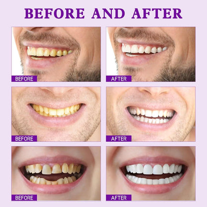 💜Purple Teeth Whitening Strips - Safe for Enamel✨🦷