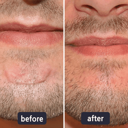💥LAST DAY SALE 60%OFF | Scar Repair Cream for Menand Women, fade scars andtighten skin in one step