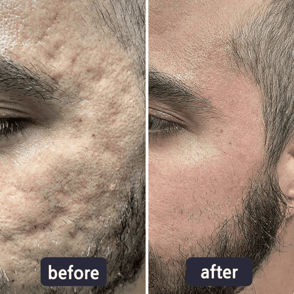 💥LAST DAY SALE 60%OFF | Scar Repair Cream for Menand Women, fade scars andtighten skin in one step