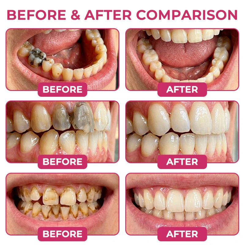 AQA Cavity-Repair Natural Enamel Filling Gel