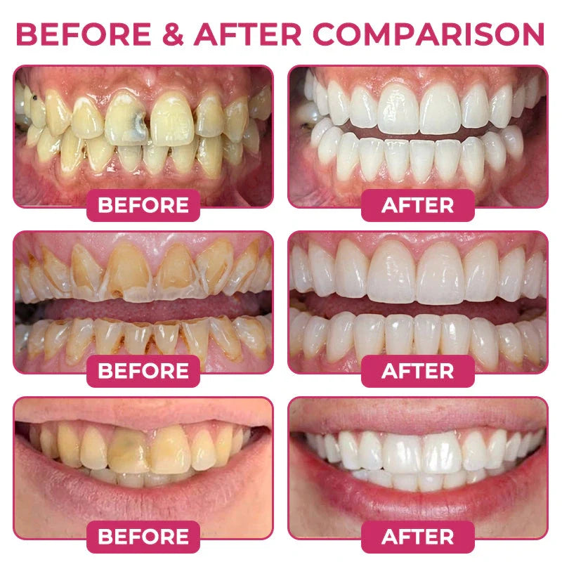 AQA Cavity-Repair Natural Enamel Filling Gel