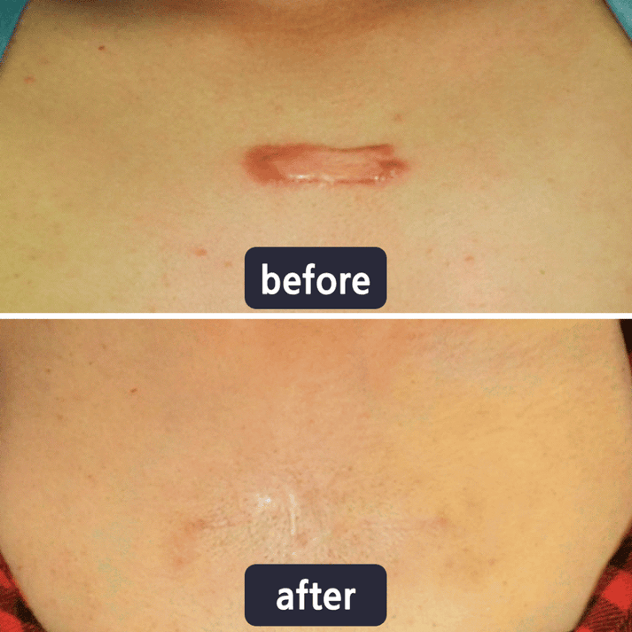 💥LAST DAY SALE 60%OFF | Scar Repair Cream for Menand Women, fade scars andtighten skin in one step