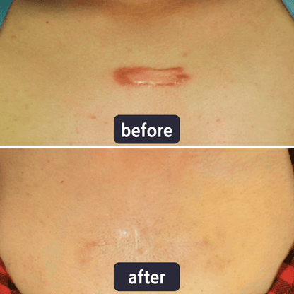 💥LAST DAY SALE 60%OFF | Scar Repair Cream for Menand Women, fade scars andtighten skin in one step