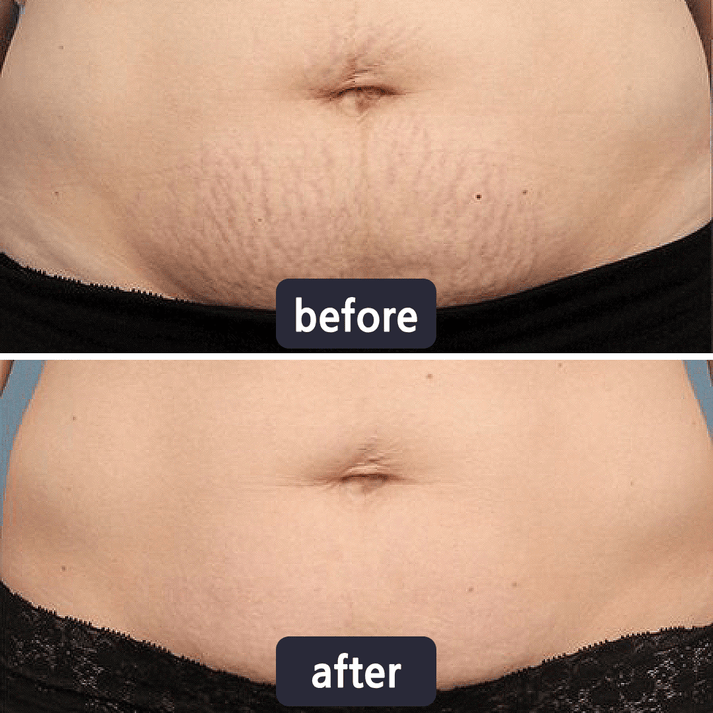 💥LAST DAY SALE 60%OFF | Scar Repair Cream for Menand Women, fade scars andtighten skin in one step