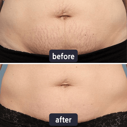 💥LAST DAY SALE 60%OFF | Scar Repair Cream for Menand Women, fade scars andtighten skin in one step